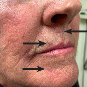 Red lesions on face