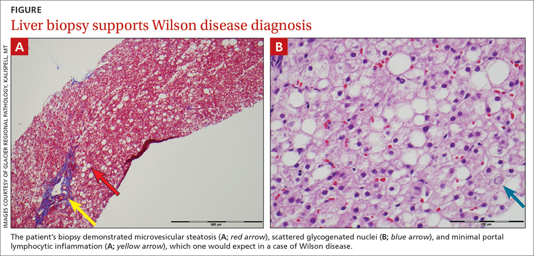 Liver biopsy supports Wilson disease diagnosis