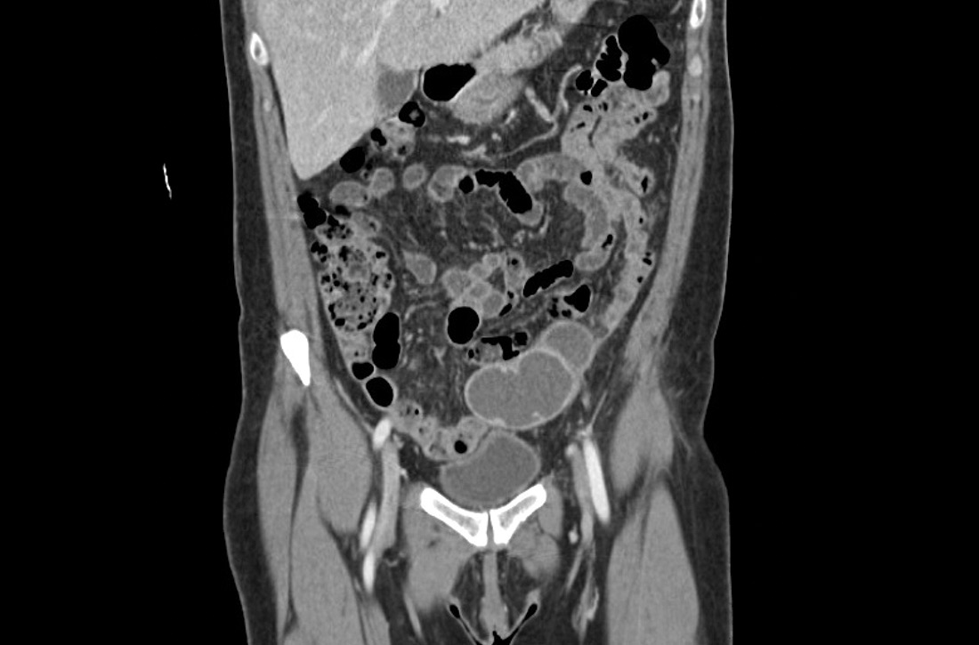 Coronal CT scan of the abdomen and pelvis