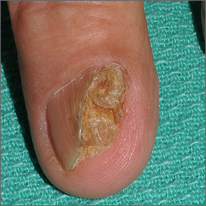 Nail growth