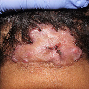 Scalp plaque