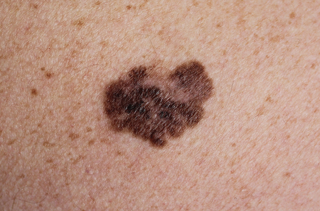 Melanoma