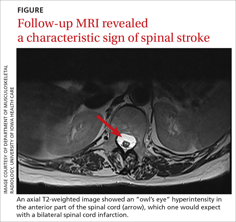 Follow-up MRI revealed a characteristic sign of spinal stroke