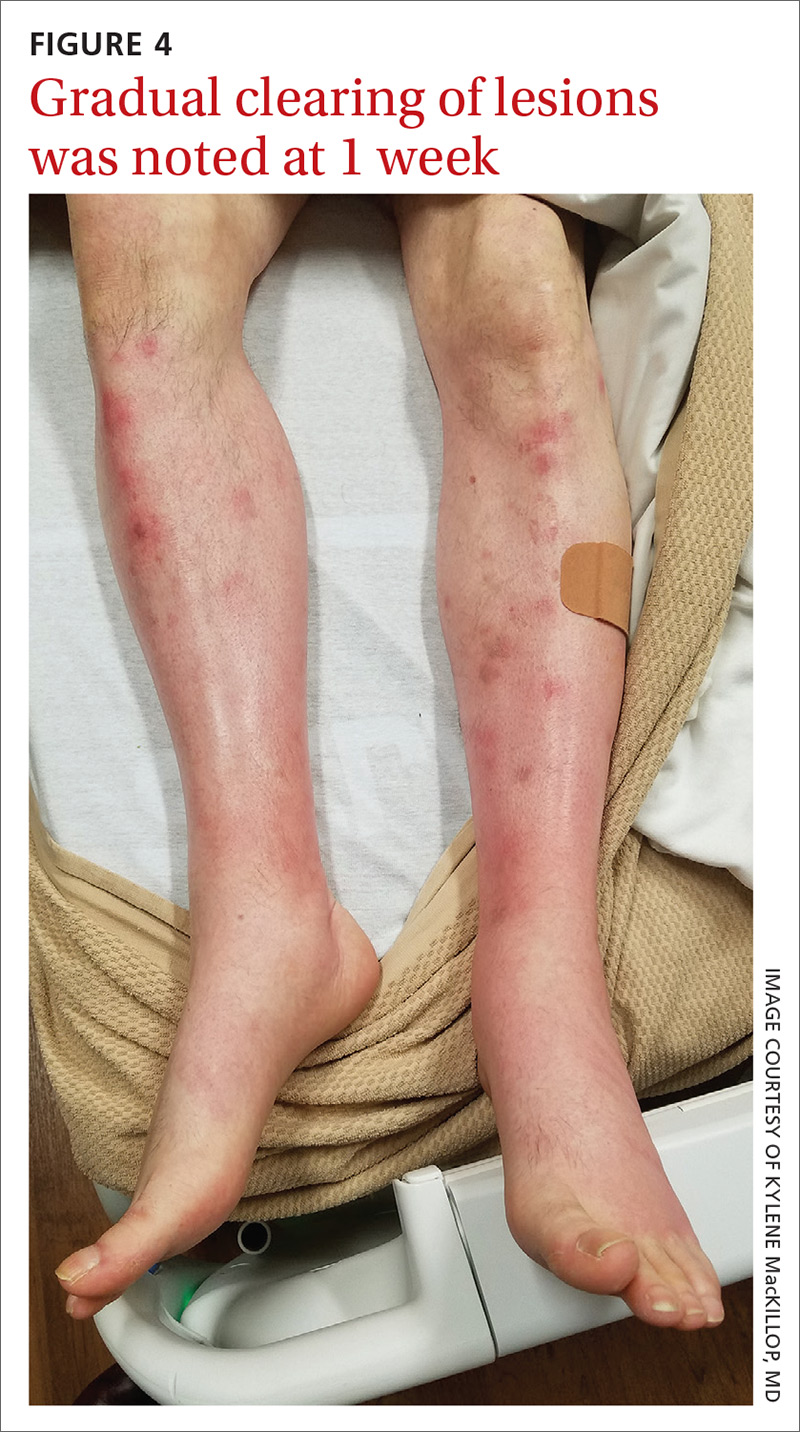 Gradual clearing of lesions was noted at 1 week