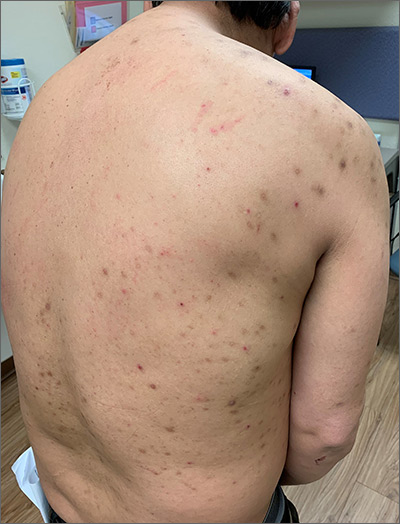 Itchy Bumps On Back Mdedge Family Medicine