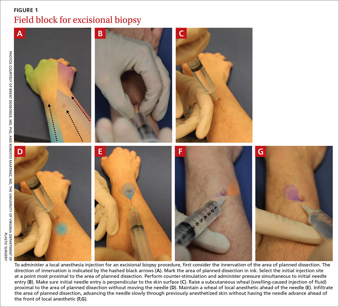 Field block for excisional biopsy