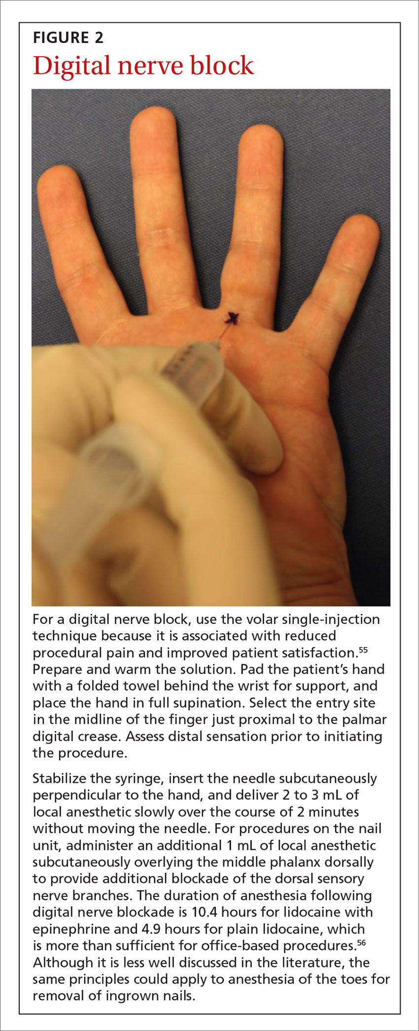 Digital nerve block