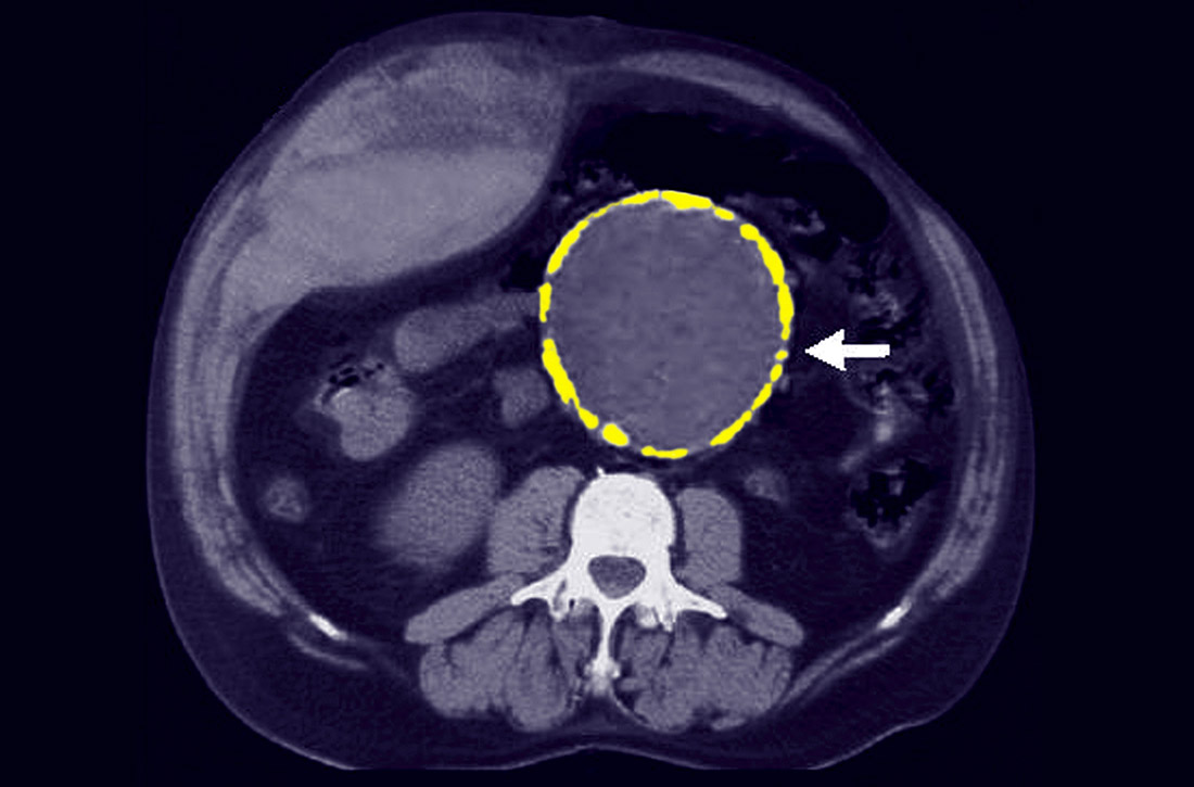 Abdominal aortic aneurysm