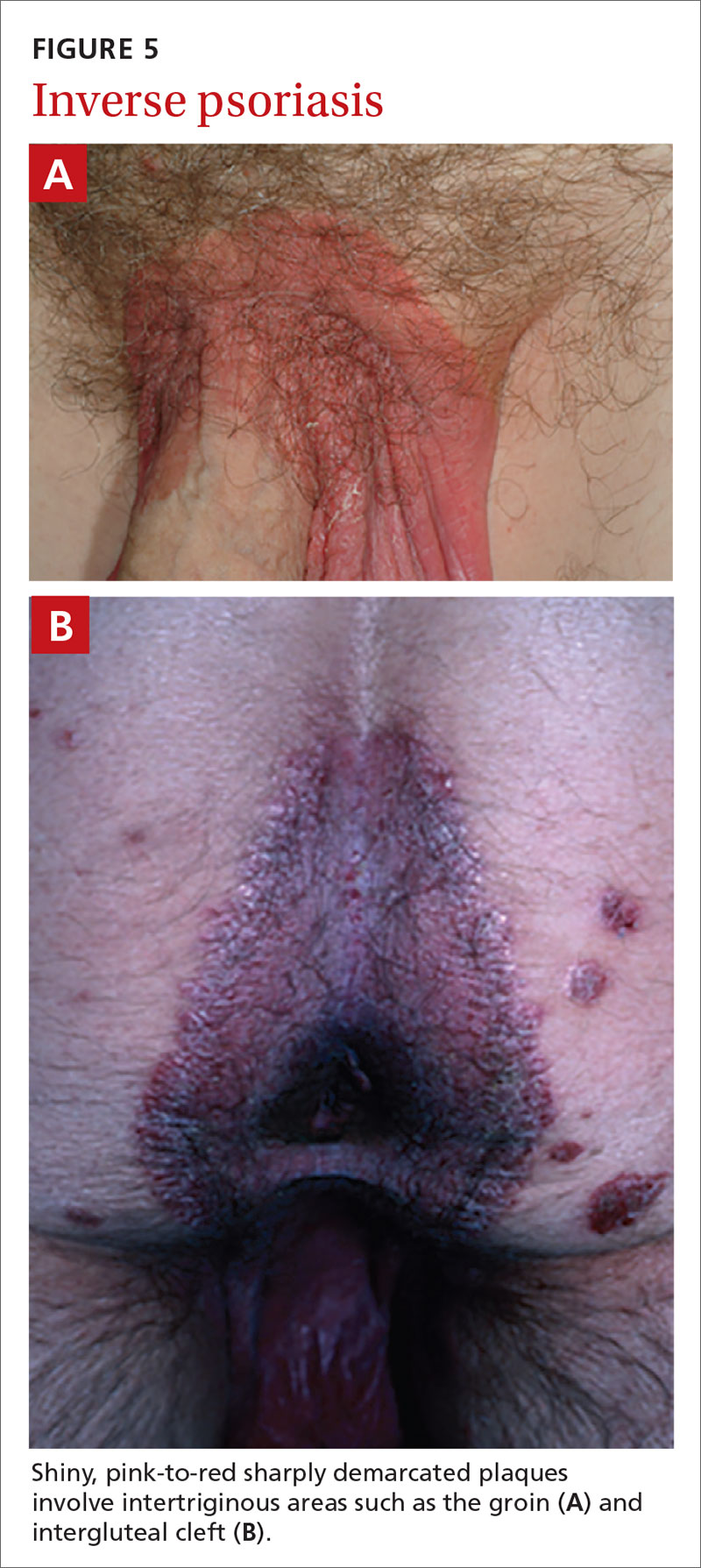 Inverse psoriasis