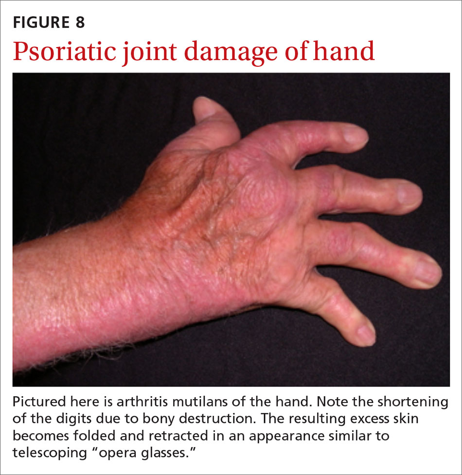 Psoriatic joint damage of hand