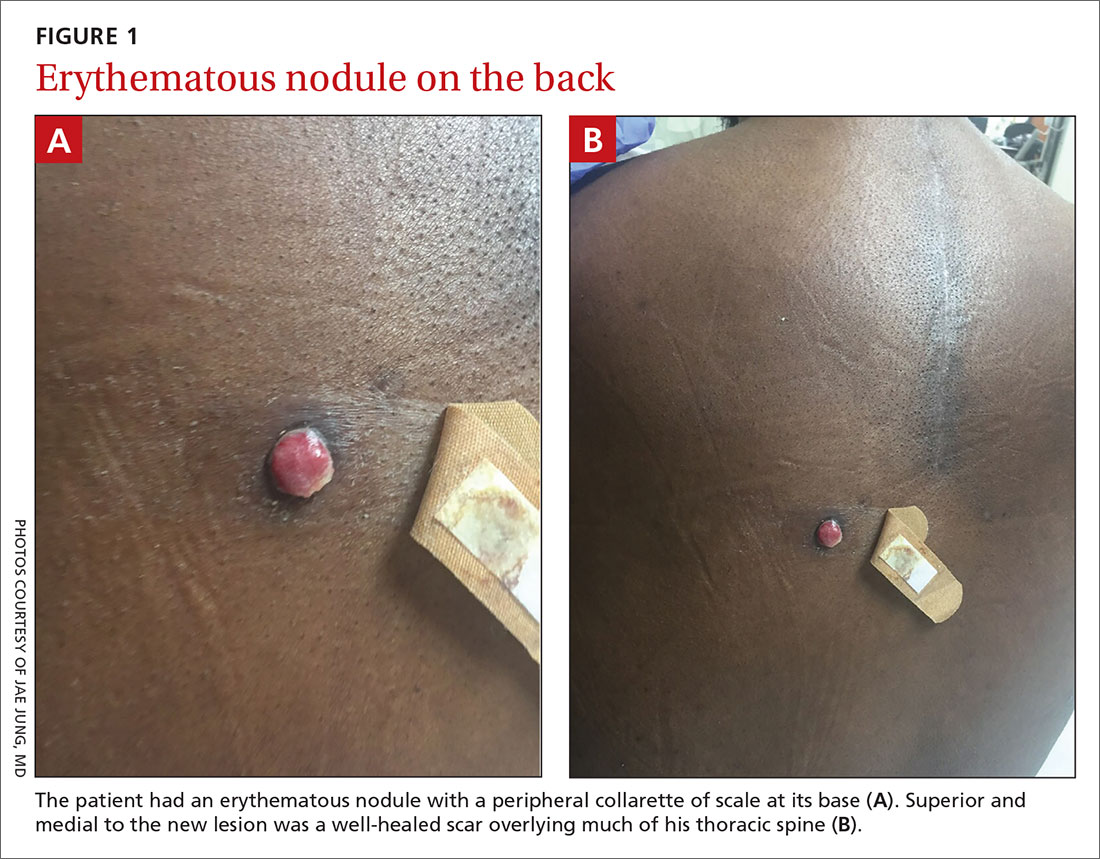 Erythematous nodule on the back