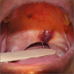 Purple oral plaques