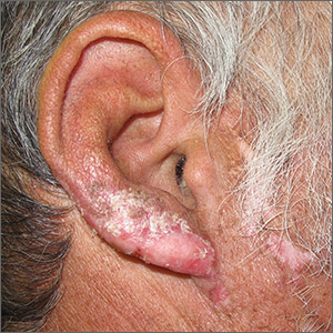 Ear plaques