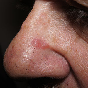 Pink nose lesion