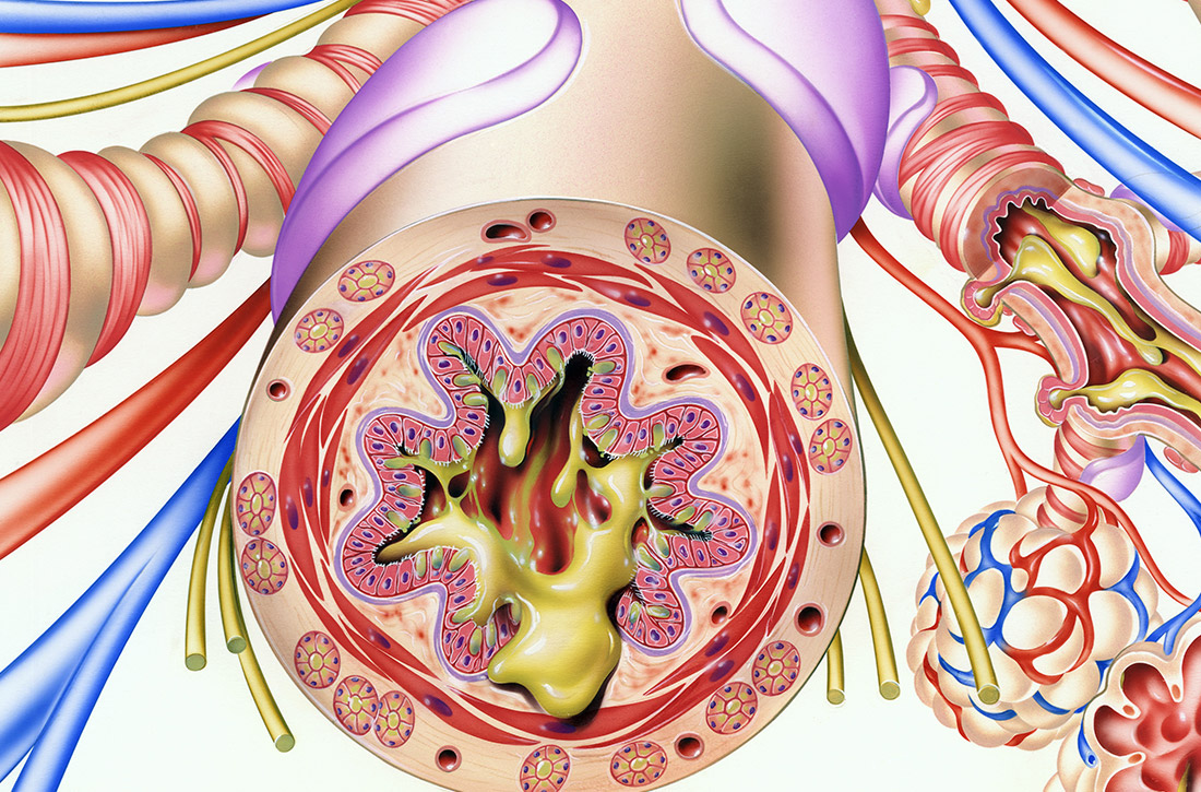 Bronchiole in a patient with asthma