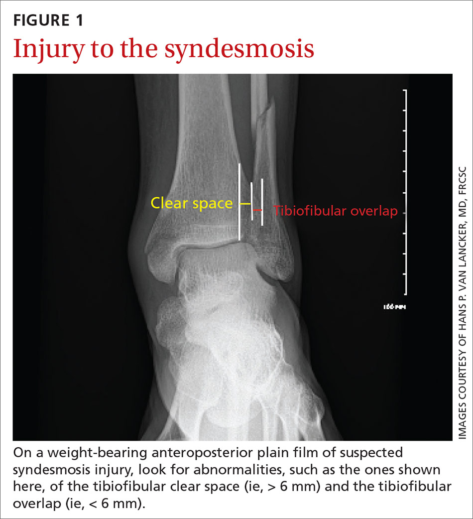 Injury to the syndesmosis