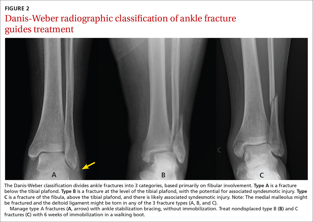 Danis-Weber radiographic classification of ankle fracture guides treatment