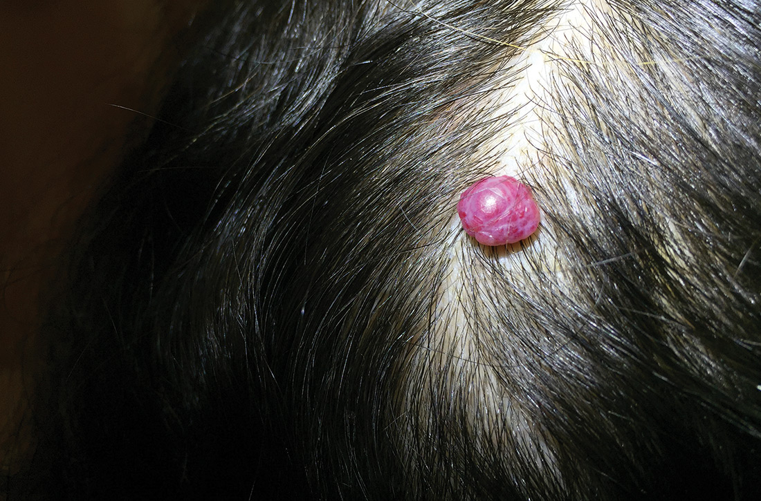 Lobulated pink nodule on the scalp