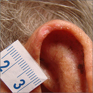 Ear lesion