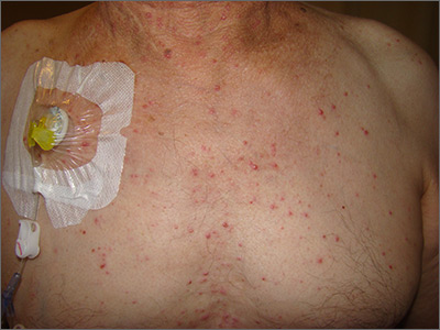 Diffuse pustules