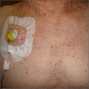 Diffuse pustules