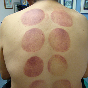 Ecchymotic patches