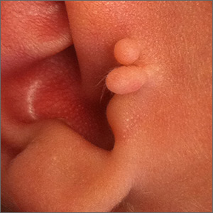 Newborn ear lesion