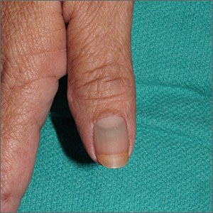 Nail discoloration