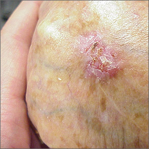 Ulcerated hand lesion