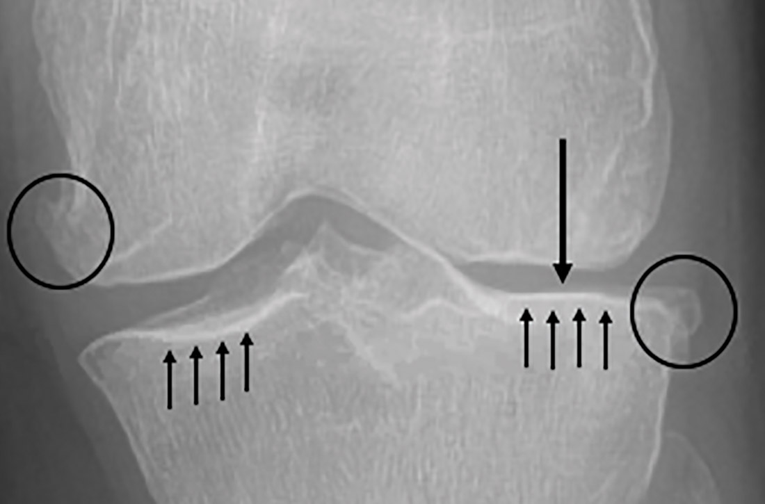 Radiographic findings of knee osteoarthritis