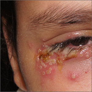 Periocular rash