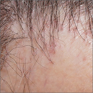 Scalp papules