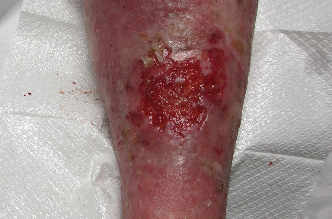 Malodorous ulceration superimposed on a psoriatic plaque