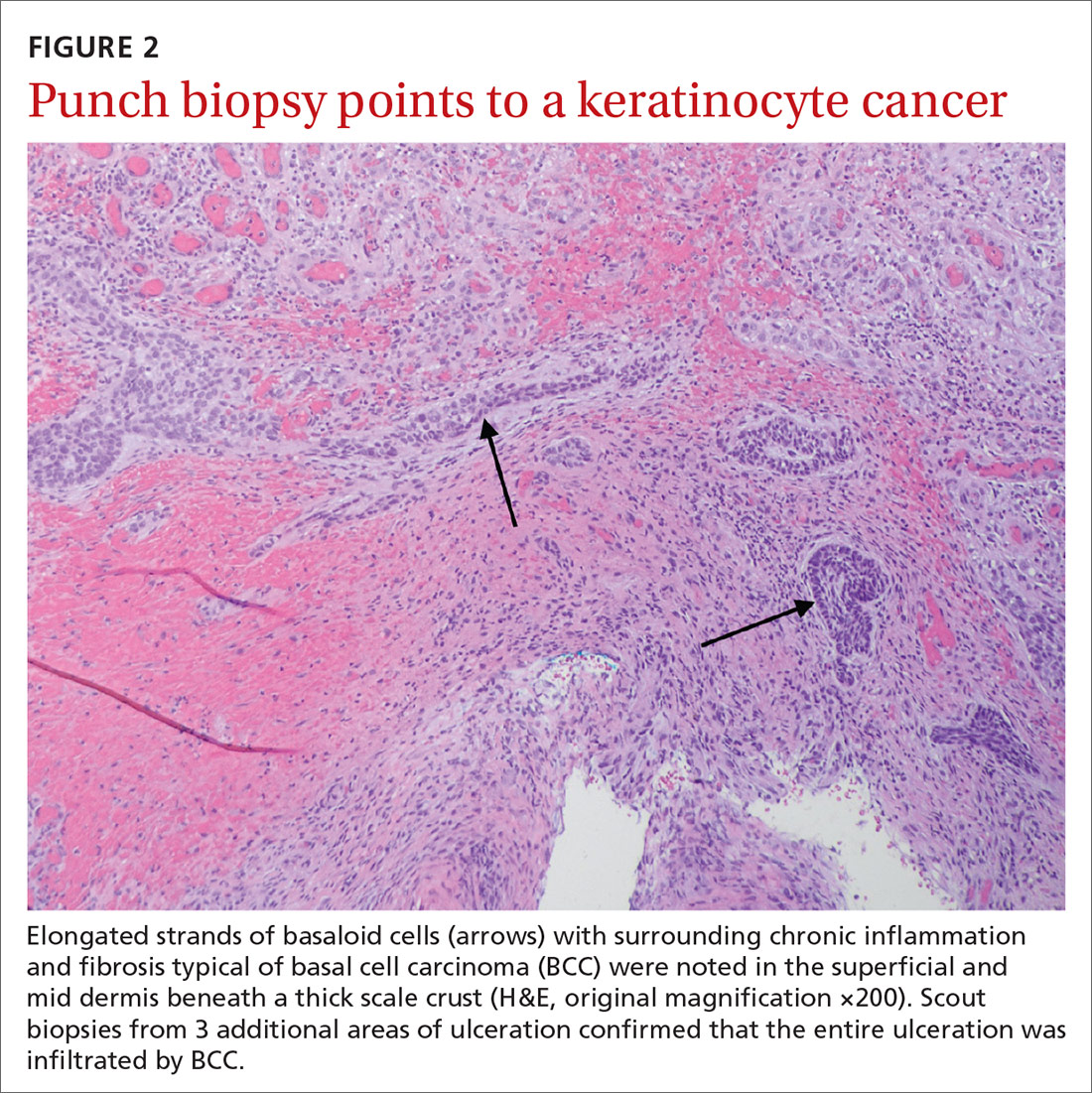 Punch biopsy points to a keratinocyte cancer