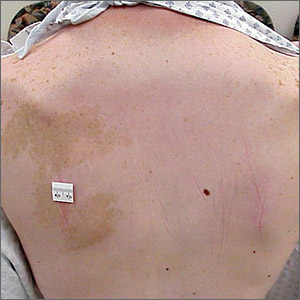 Hyperpigmented patch on back