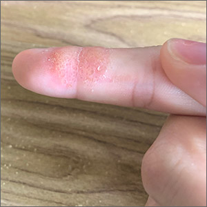 Small blisters on finger