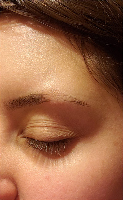 Eyebrow hair loss | MDedge Family Medicine