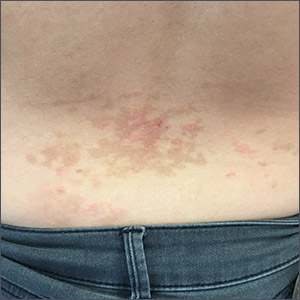 Pruritic rash