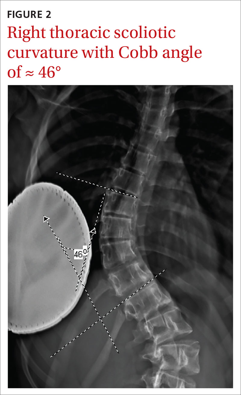 Right thoracic scoliotic curvature with Cobb angle of ≈ 46°