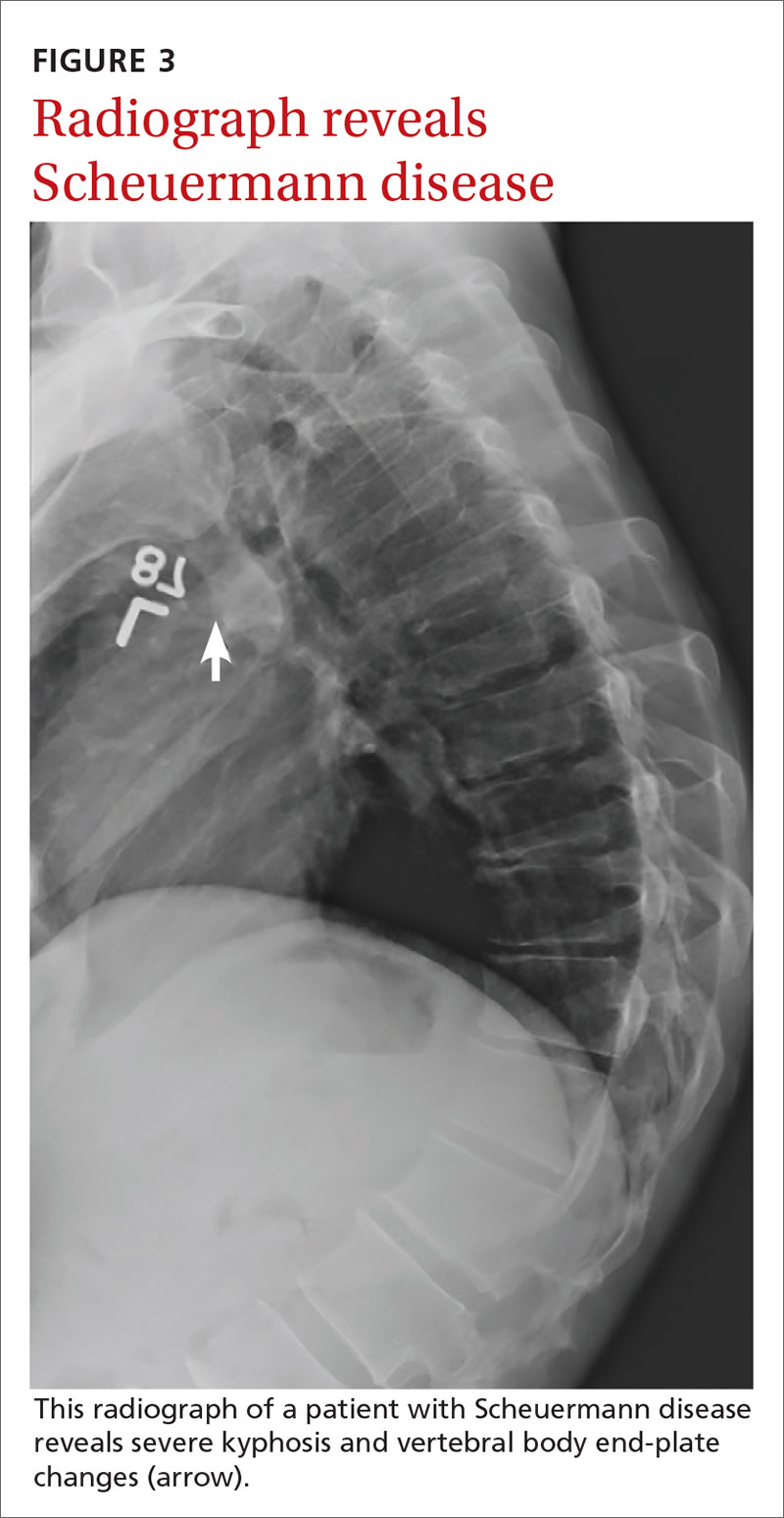 Radiograph reveals Scheuermann disease 