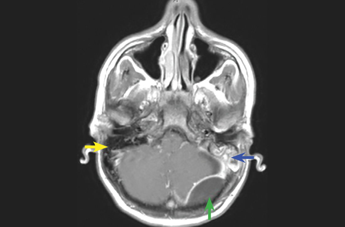 MRI of a 12-year-old boy with severe left ear pain, localized headache, and otitis media