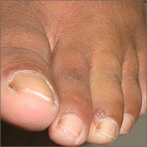 Purple toe lesion