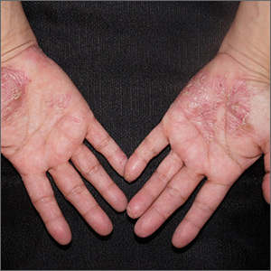 Pustules on hands