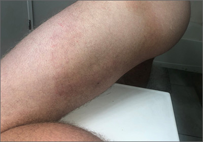 How to treat a circular rash on my inner thigh - Quora