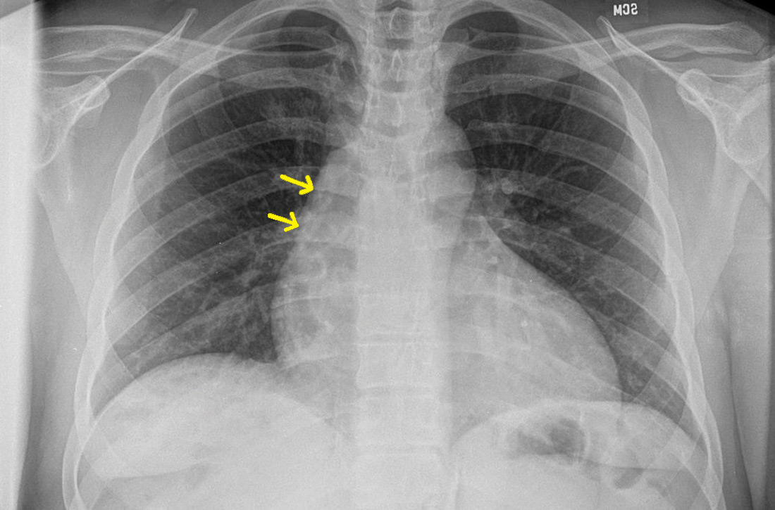 Increasing ectasia of the ascending thoracic aorta