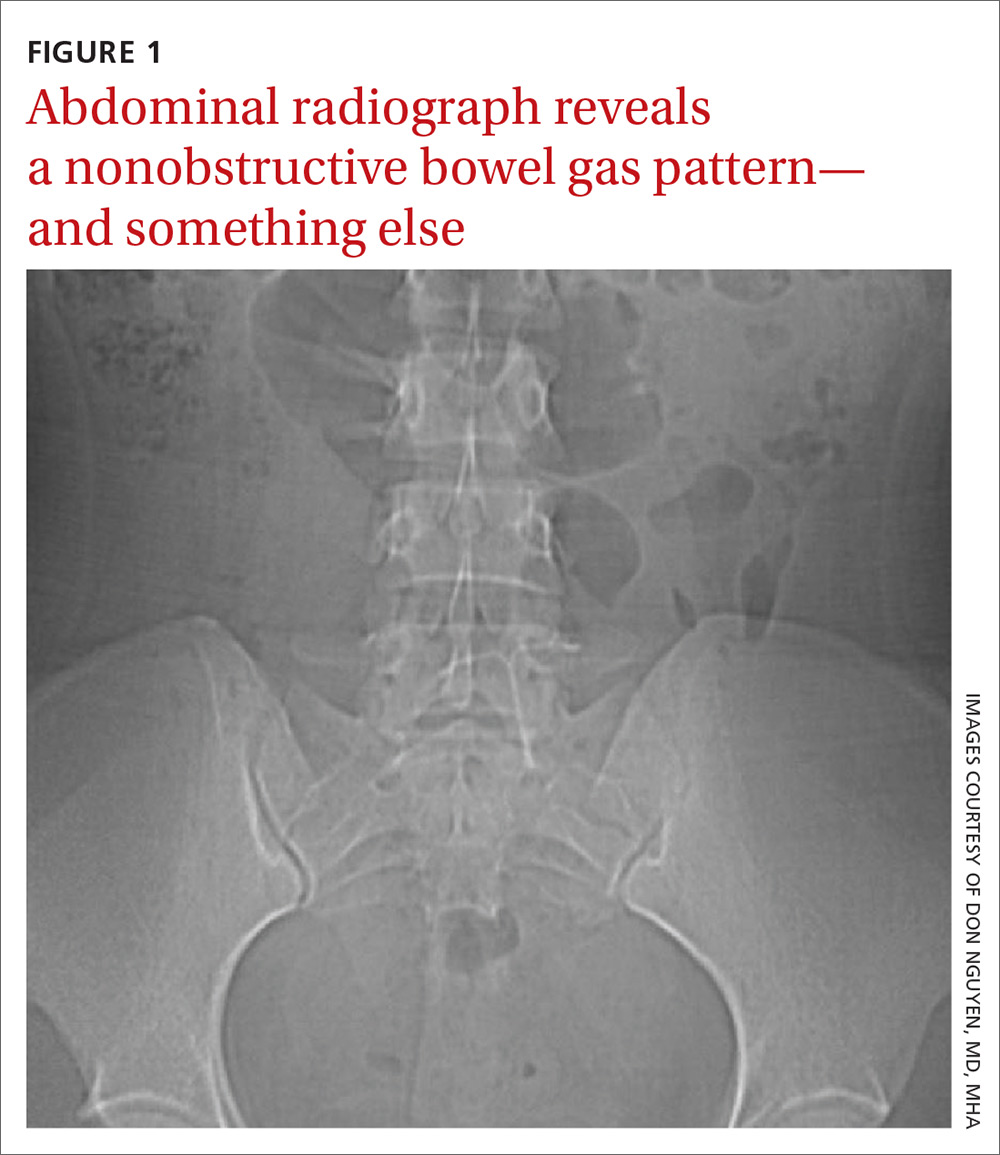 Nonobstructive bowel gas pattern