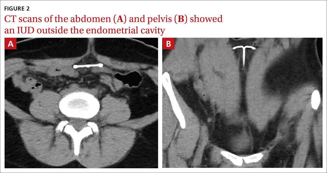 IUD outside the endometrial cavity