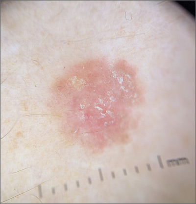 Scaly lesion on forearm