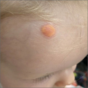 Yellow nodule on child's forehead