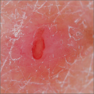 Pink papule on thigh